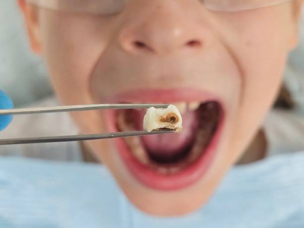 Best Emergency Treatment for Oral Infections in Addison, TX
